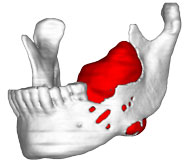 Jaw Tumor